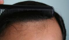 Before Hair Transplant&nbsp;Front